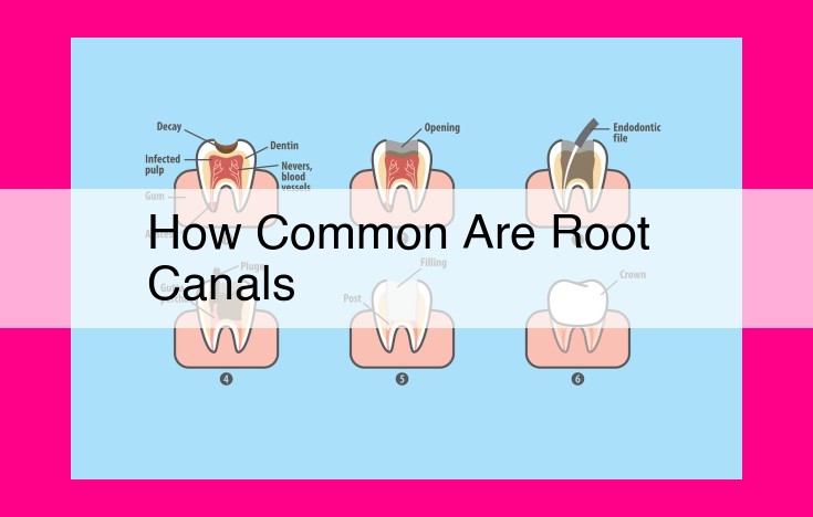 how common are root canals