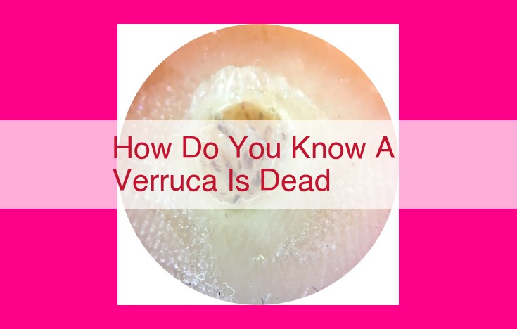 how do you know a verruca is dead