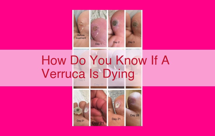 how do you know if a verruca is dying