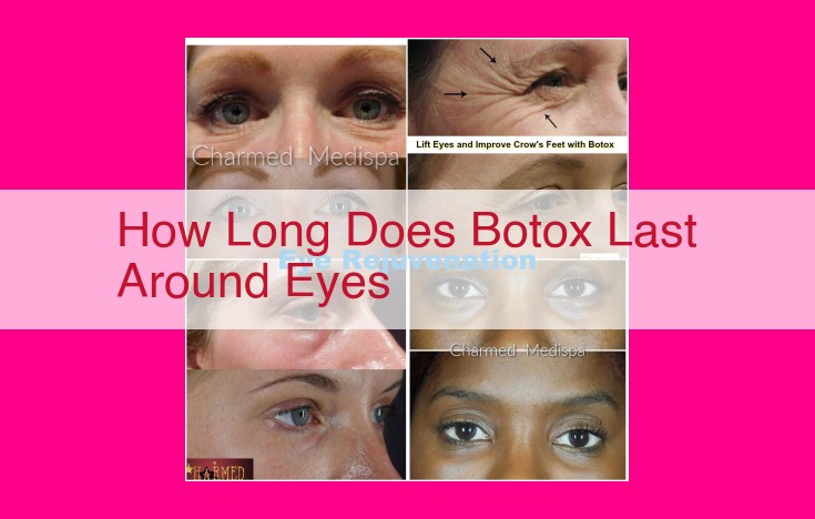 how long does botox last around eyes