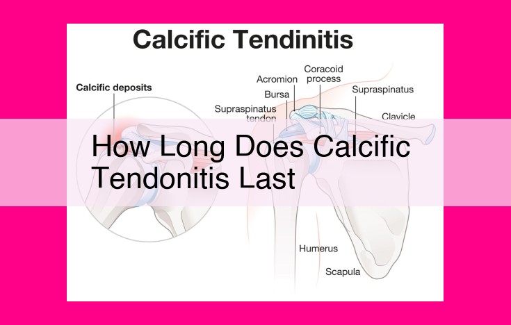 how long does calcific tendonitis last