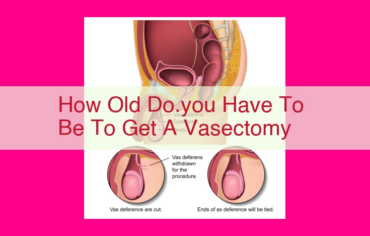 how old do.you have to be to get a vasectomy