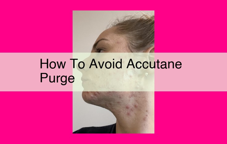 how to avoid accutane purge