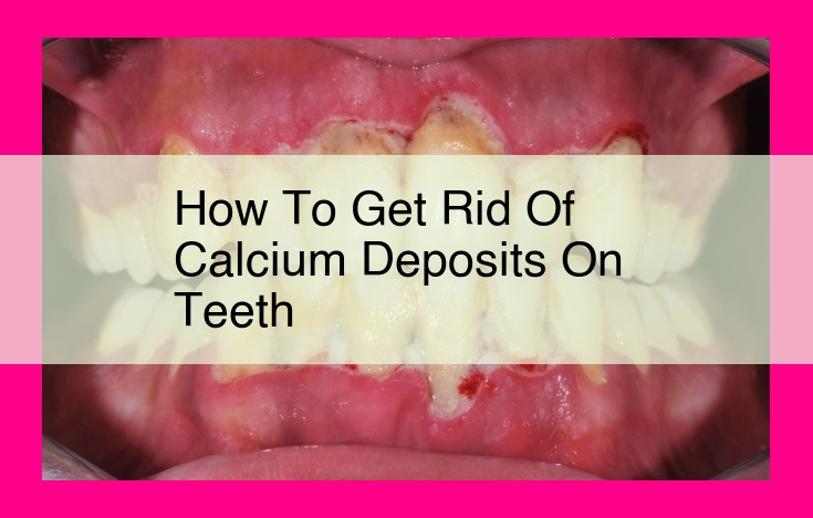 how to get rid of calcium deposits on teeth