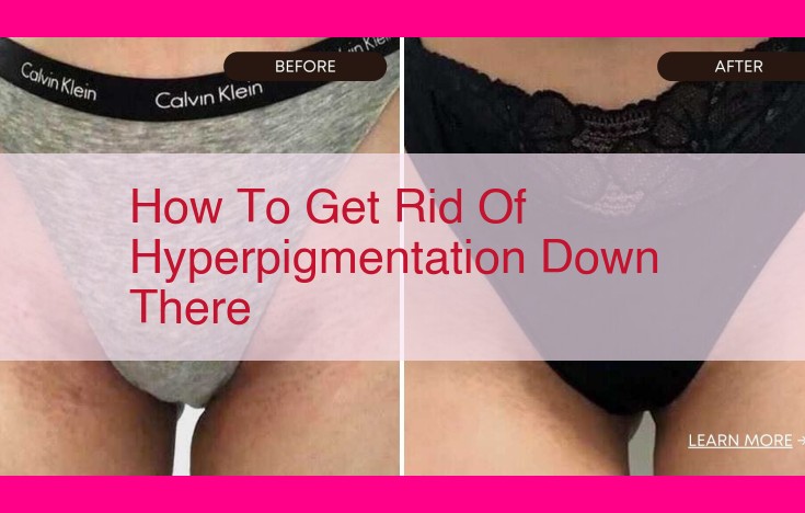 how to get rid of hyperpigmentation down there