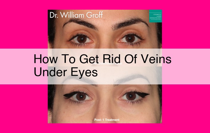 how to get rid of veins under eyes