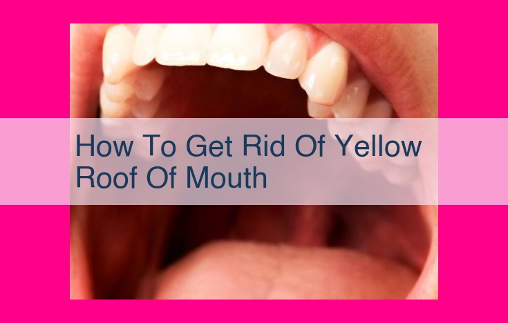 how to get rid of yellow roof of mouth