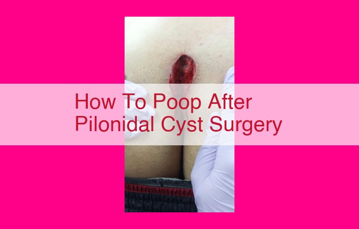 how to poop after pilonidal cyst surgery