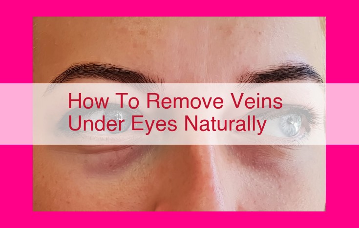 how to remove veins under eyes naturally