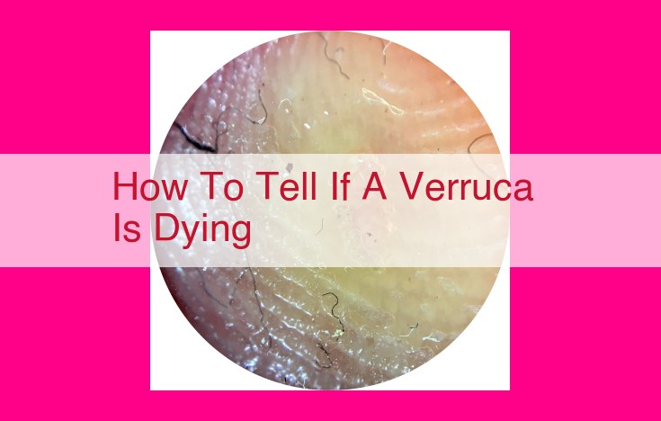 how to tell if a verruca is dying